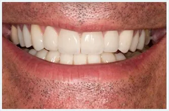 caradonna_after_extreme_smile_makeover