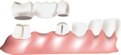 dental crown - bridge