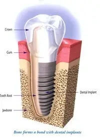 dental implant cut