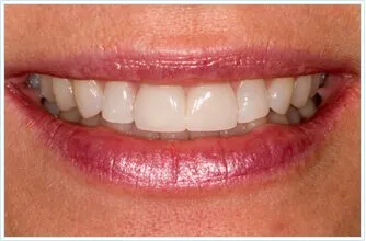 gehrmann_after_smile_enhancement