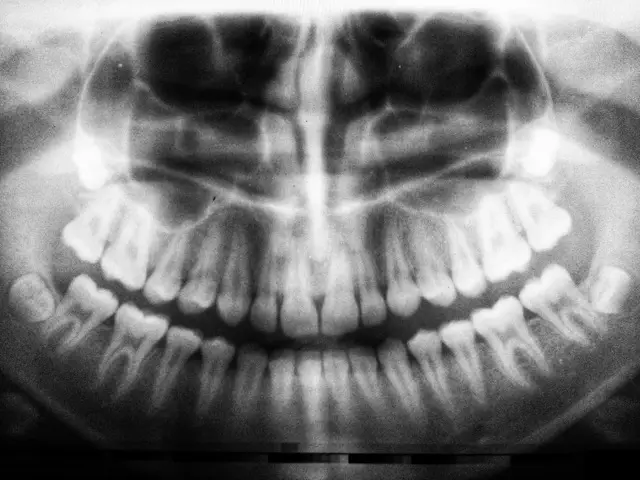 What Is Cosmetic Dentistry and how x-ray image shows complete tooth view Westcoast Smile Dental Vancouver