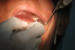 Wisdom tooth assessment at Westcoast Smile Dental in Kitsilano, Vancouver