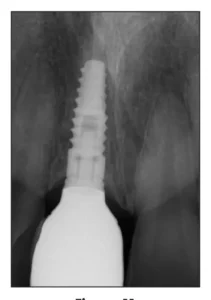 x-ray shows complete Dental implants vancouver Dr. Cheng Journal in Toronto Dental Association Journal