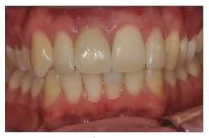 image shows successful Dental implants vancouver Dr. Cheng Journal in Westcoast Smile Dental Vancouver BC