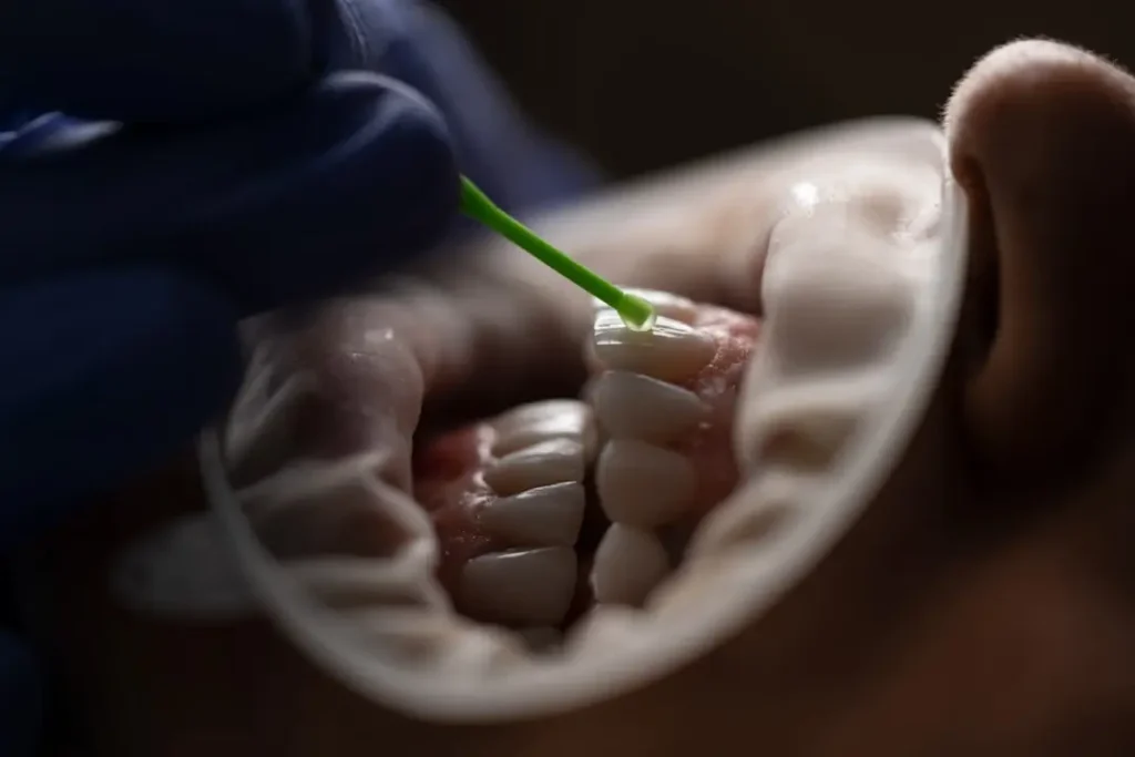 tooth are are shown while porcelain veneers application procedure