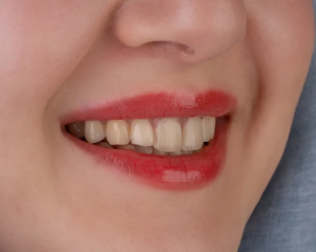 smile makeover shown after porcelain veneers procedure