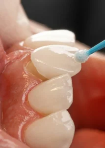 tooth are are shown while porcelain veneers application procedure