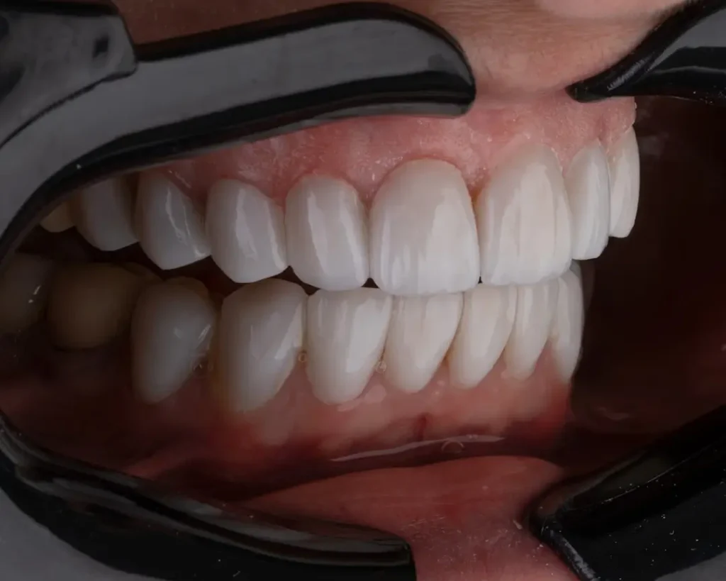 tooth are are shown after porcelain veneers procedure