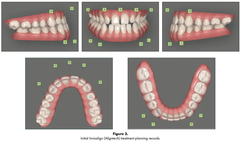 Invisalign + Veneers workflow diagram (Align → Mockup → Veneers → Finish) - Westcoast Smile Dental Vancouver