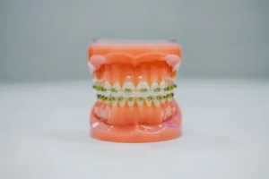 Braces in vancouver Westcoast Smile Dental
